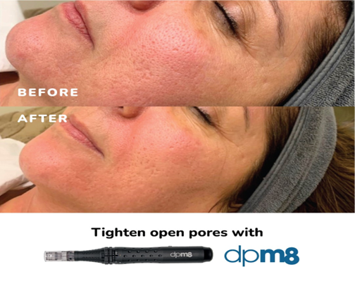 Microneedling-Dermapen-Image-1